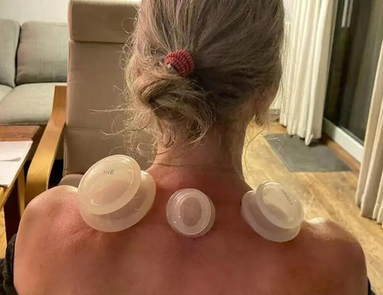 Person ses bagfra med håret samlet op, mens tre gennemsigtige cupping-kopper sidder på øvre ryg og nakke i et hjemmemiljø.