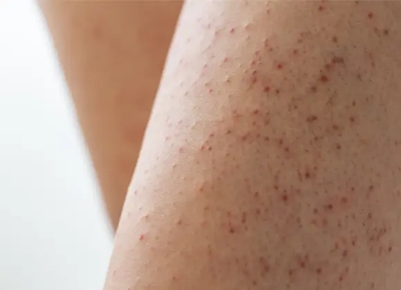 Nærbilde av hud på ben med mange små røde nupper og ujevn hudstruktur, som tydelig viser hudens overflate innen kropppleie og skincare.