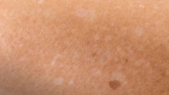 Närbild på en arm med hypopigmentering, mot en blå bakgrund.
