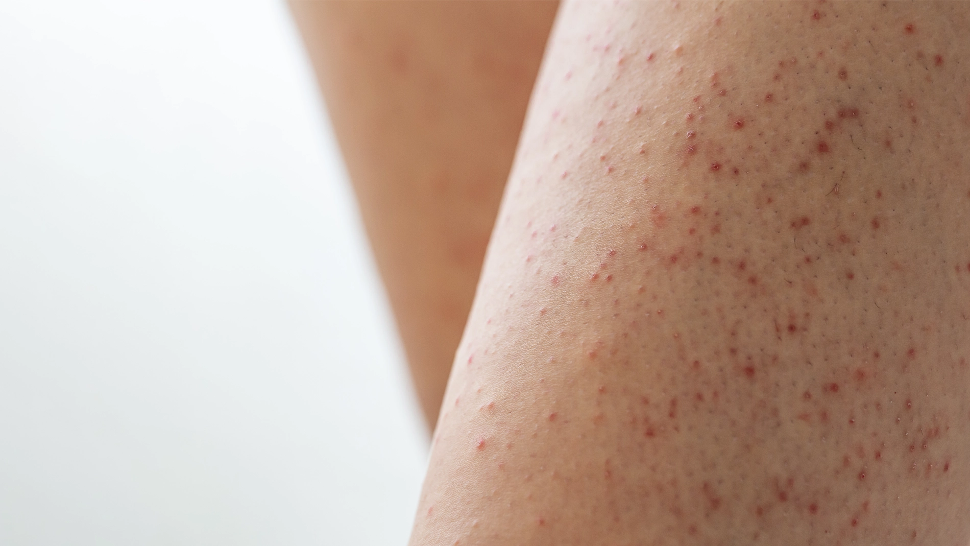 Nærbilde av hud på ben med mange små røde nupper og ujevn hudstruktur, som tydelig viser hudens overflate innen kropppleie og skincare.