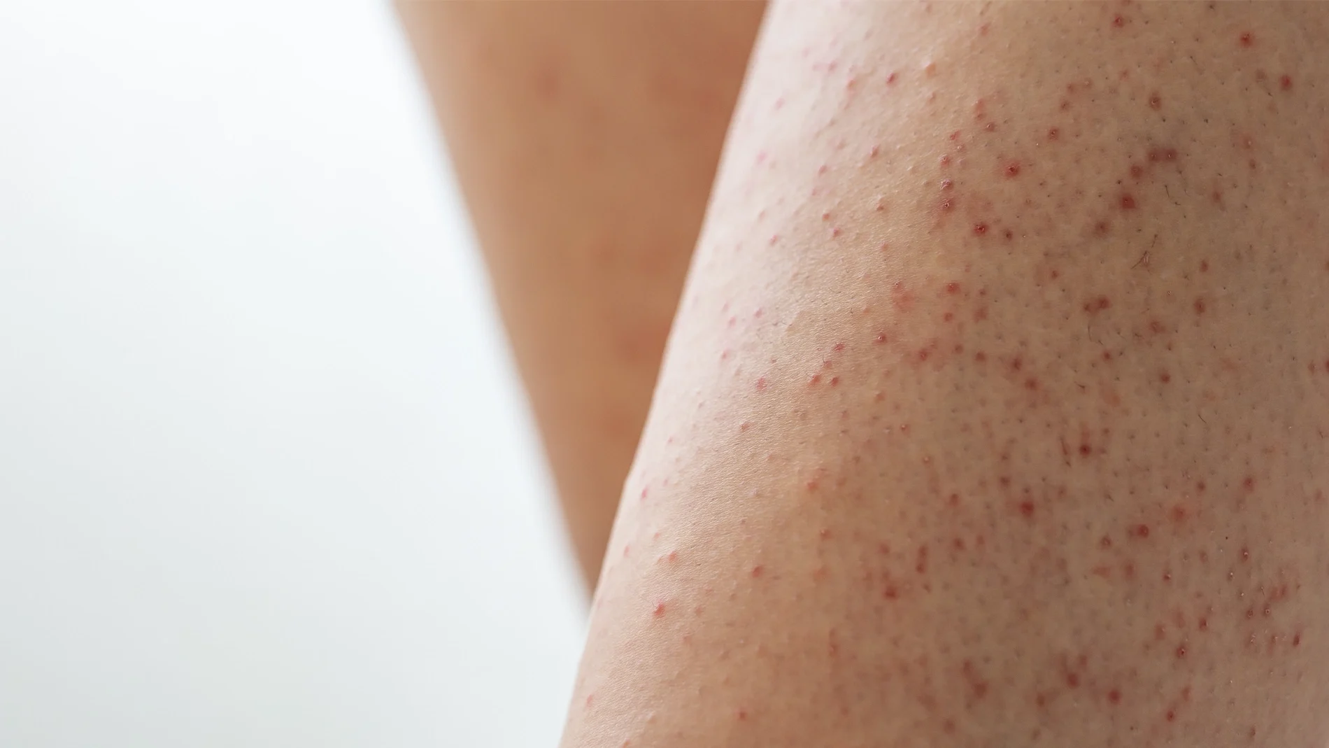 Närbild av hud på ben med många små röda knottror och ojämn hudstruktur, vilket synliggör hudens yta i detalj inom kroppsvård och skincare.