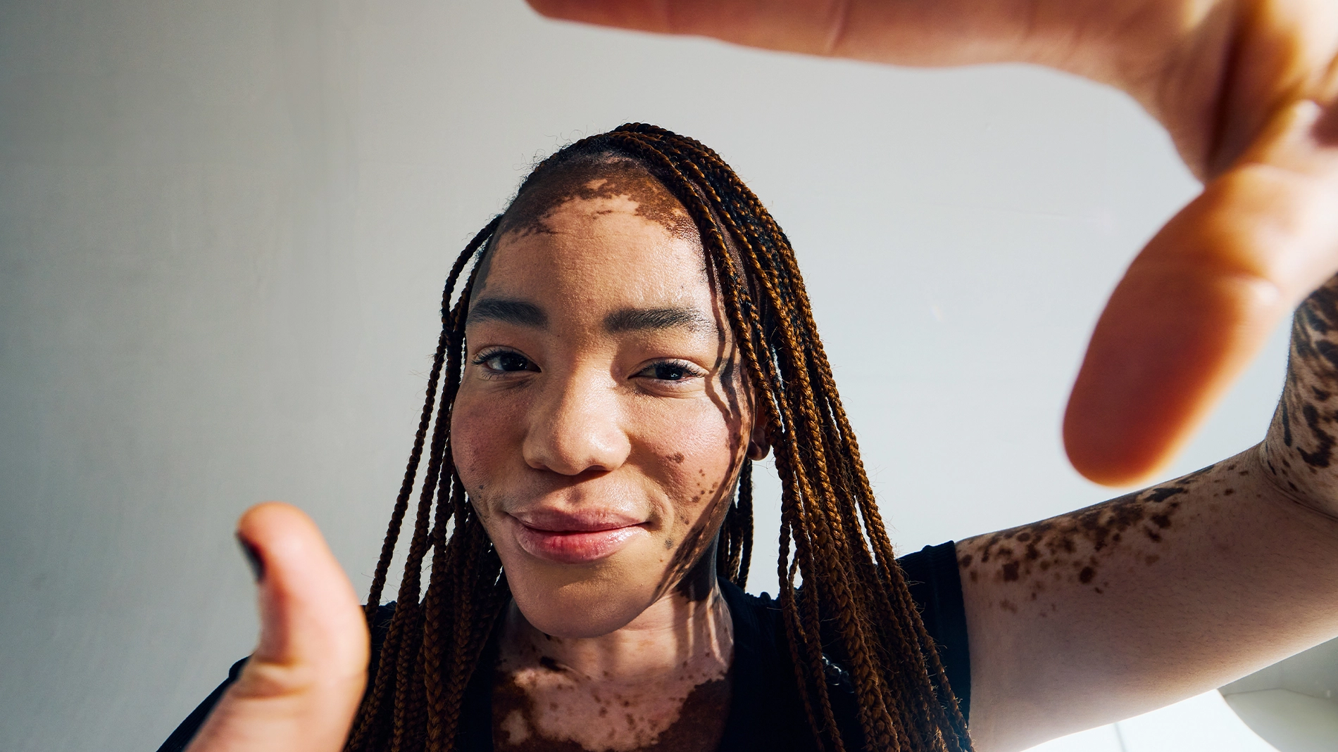 Henkilö, jolla on pitkät letitetyt hiukset ja vitiligo, pitää käsiään ylhäällä.