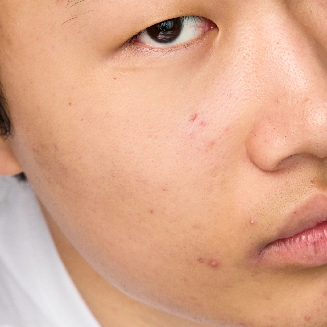 Närbild av kind med akne, små finnar och lätt rodnad i huden.