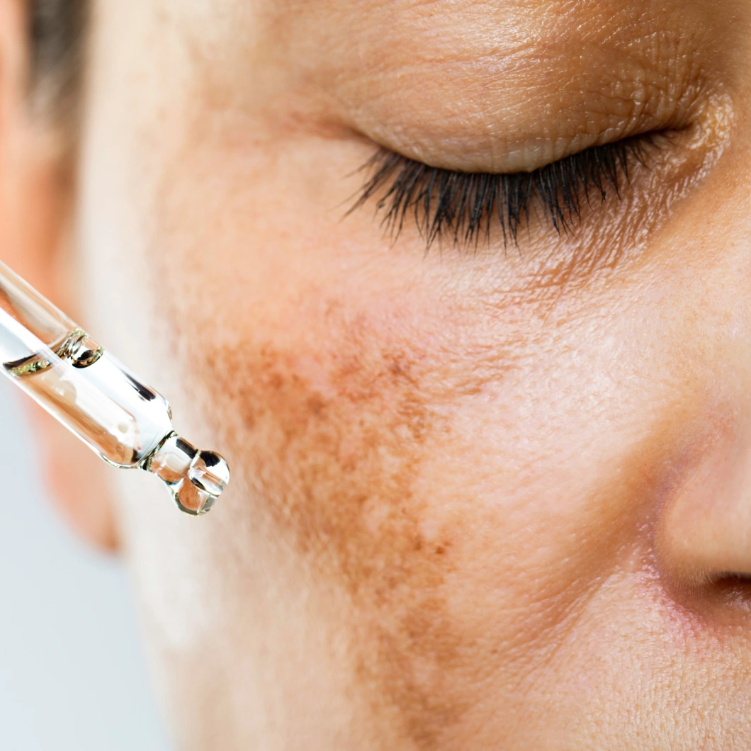 Nærbilde av kinn der en pipette påfører et transparent serum på huden med synlige pigmentforandringer.