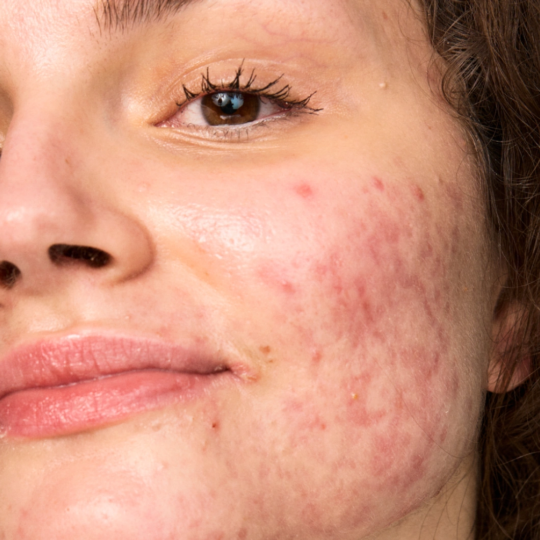Nærbilde av kinn med synlige akneutbrudd, rødhet og ujevn hudtekstur uten sminke.