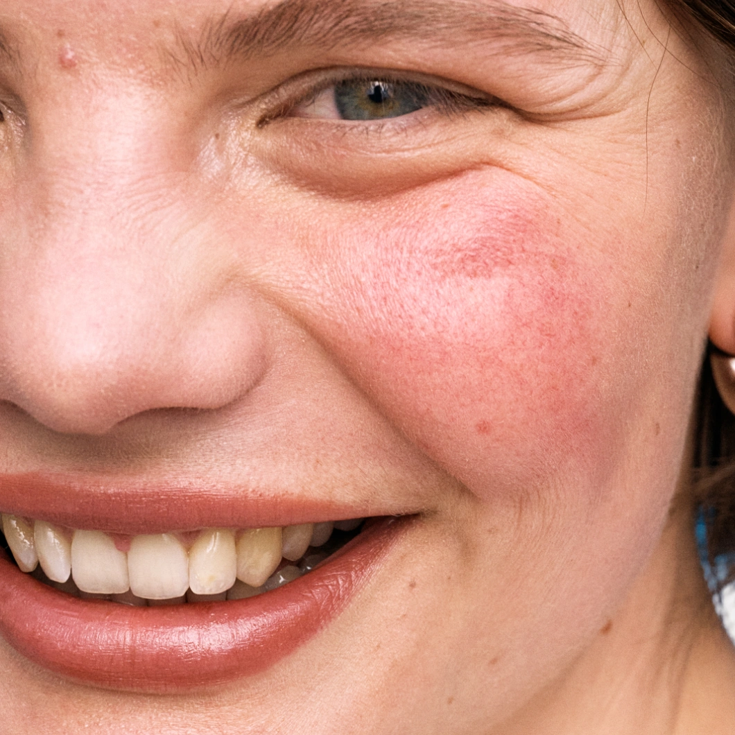 Nærbilde av kinn med tydelig rødhet og ujevn hudtone, en person smiler og viser hud med synlig irritasjon.