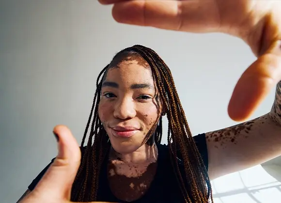 Henkilö, jolla on pitkät letitetyt hiukset ja vitiligo, pitää käsiään ylhäällä.