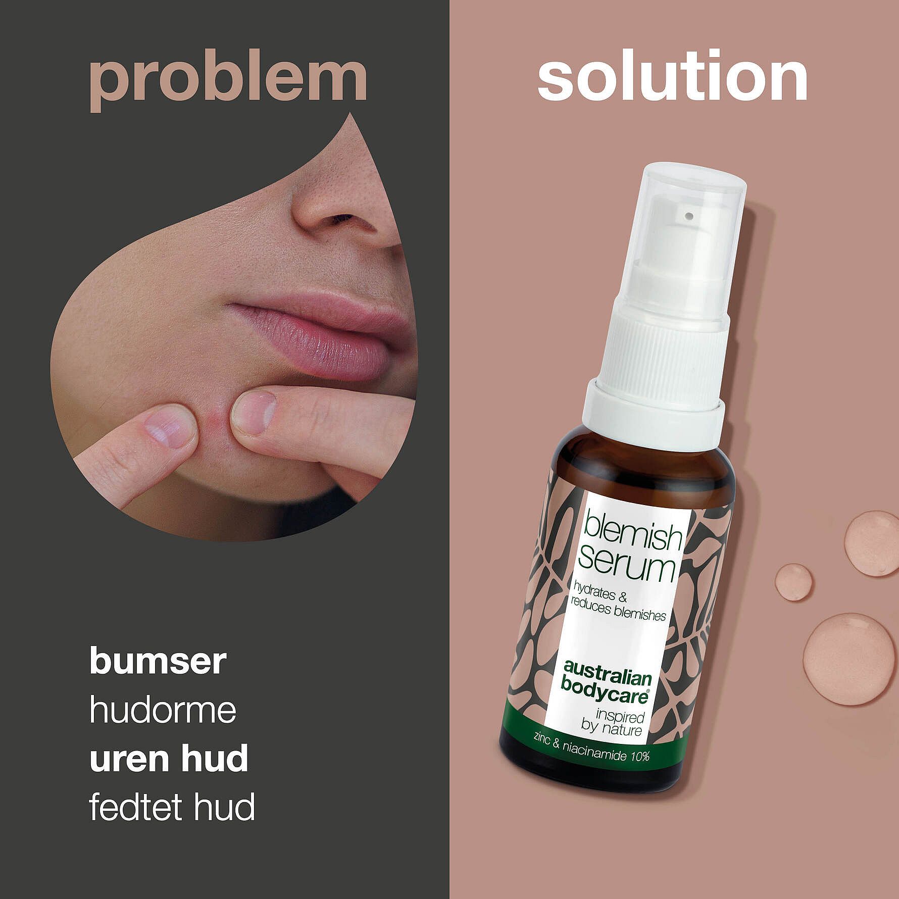 10% Niacinamide Blemish Serum – For Pimples, Blackheads And Oily Skin