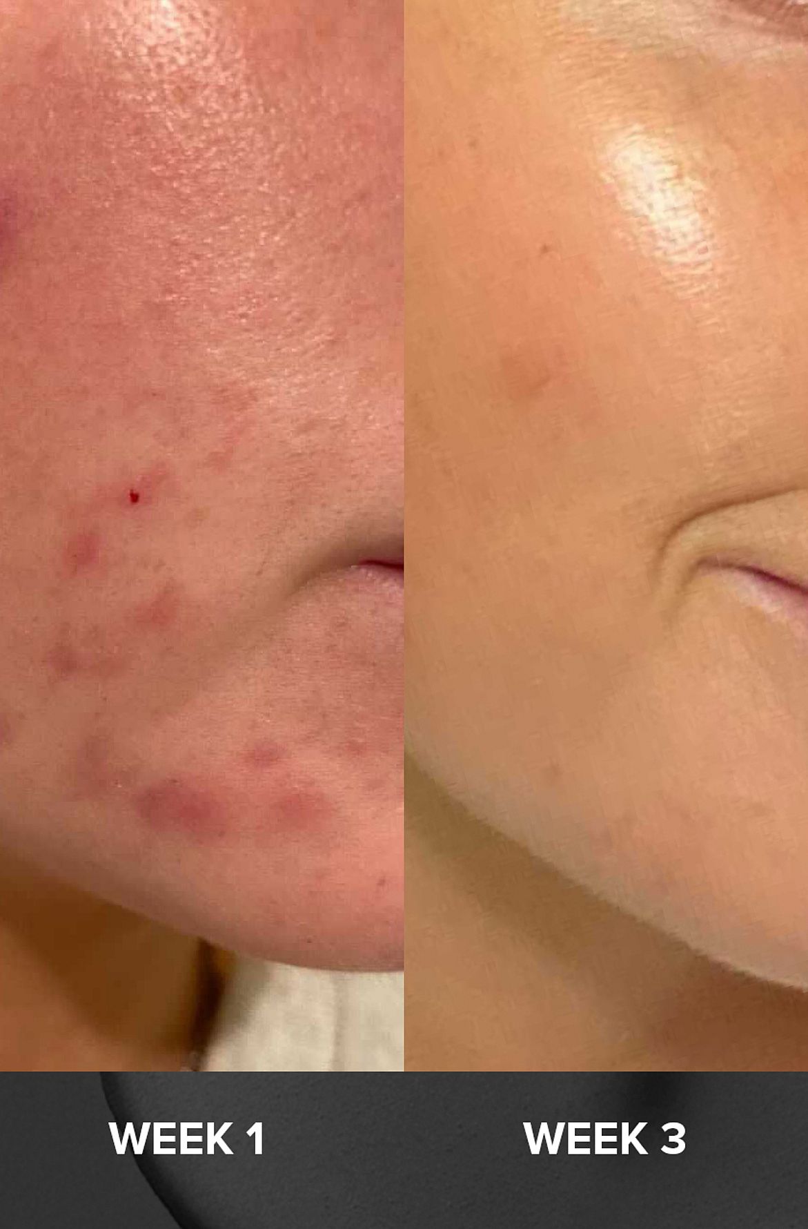 Skin Perfecting 2% BHA Liquid Exfoliant